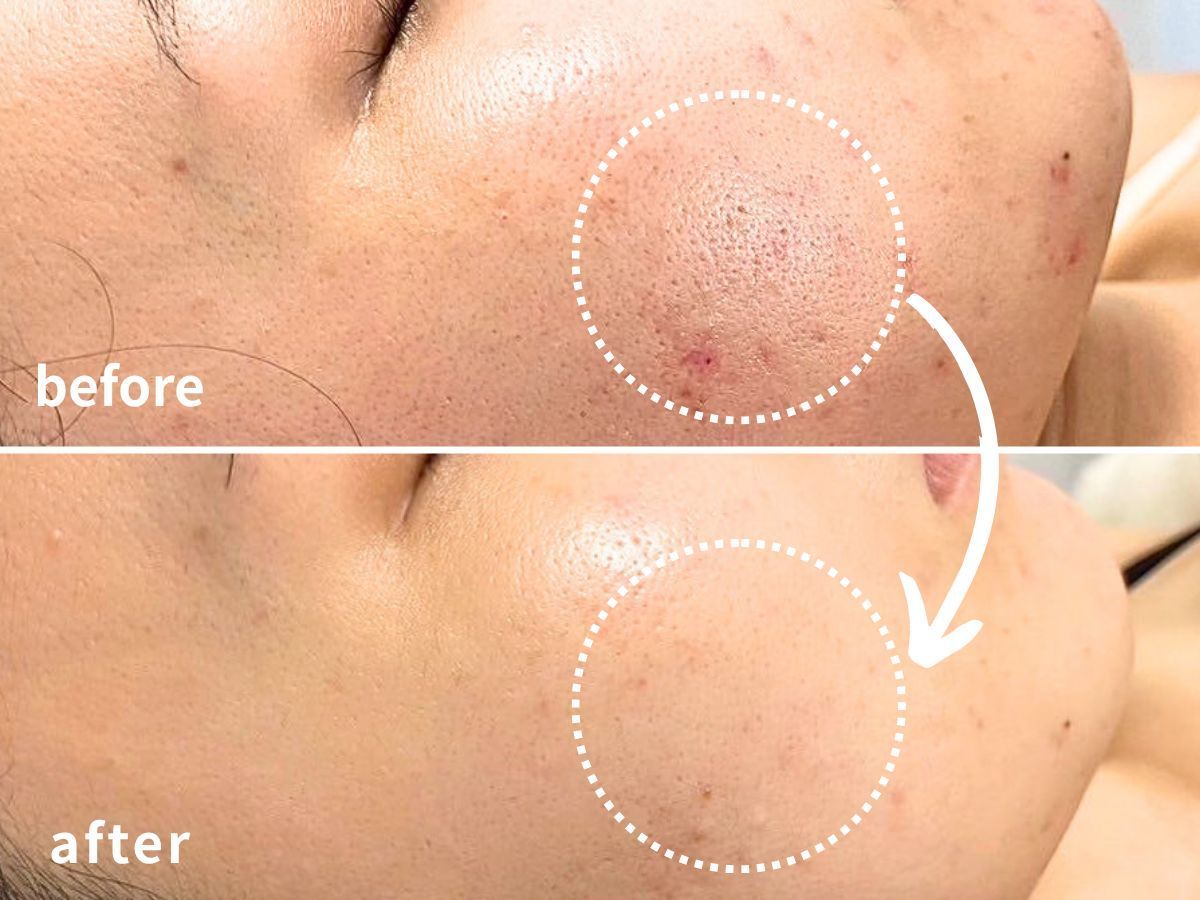 ダクトピールの施術でのbefore＆afterの写真１