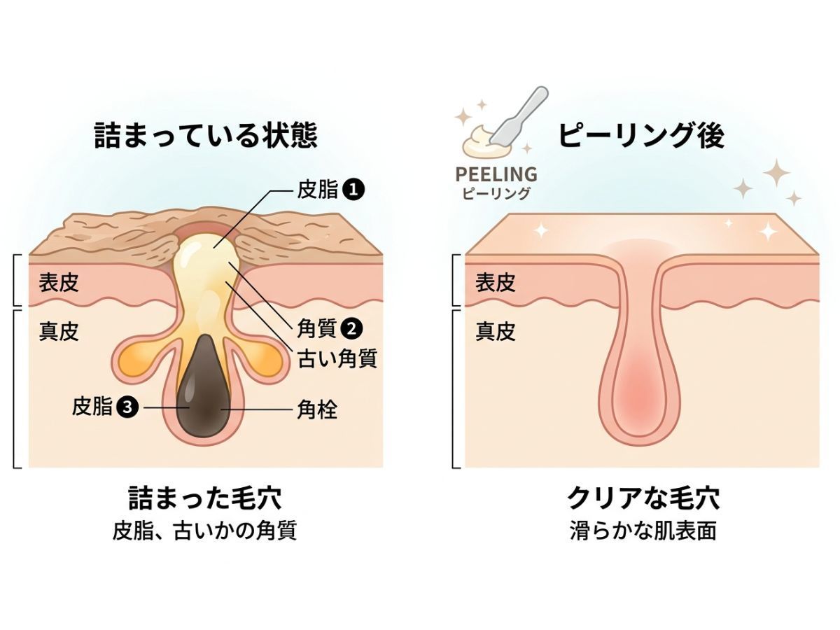 毛穴の黒ずみの原因 皮脂と角栓のイメージ