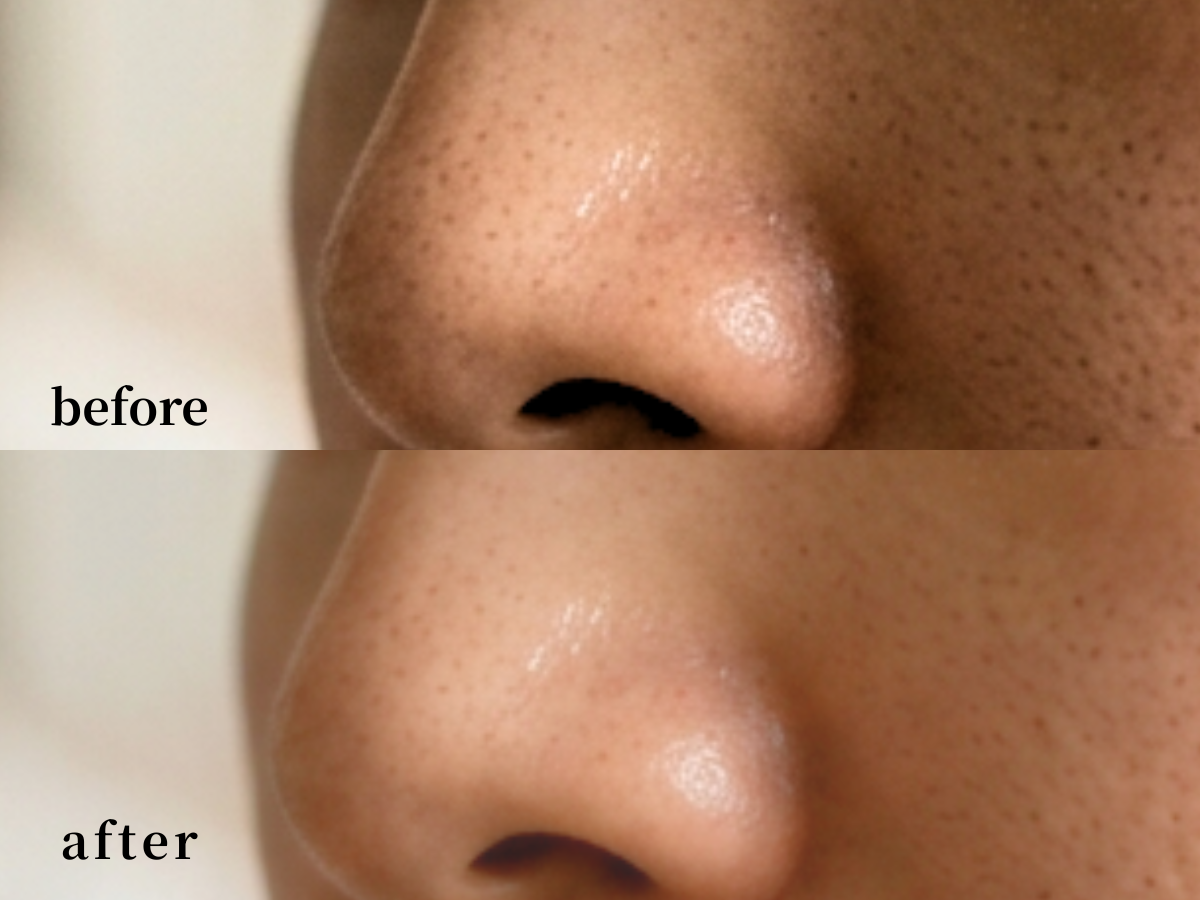 ダクトピールの施術でのbefore＆afterの写真２