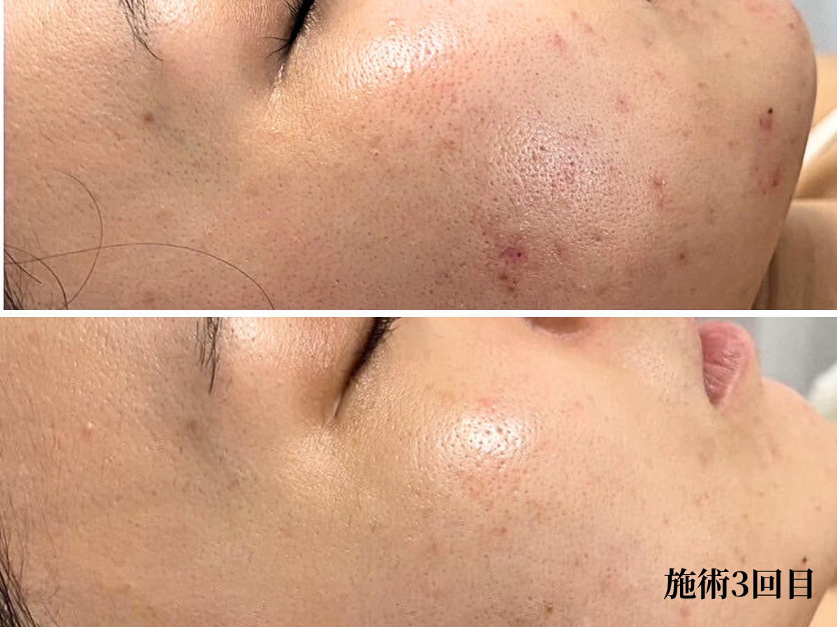 京都・四条烏丸のララピール｜3回施術後の肌質改善写真