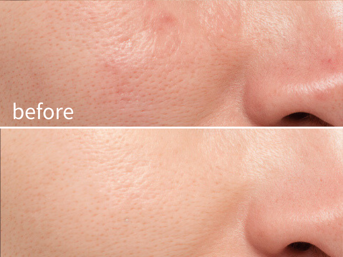 京都・四条烏丸｜肌のハリ・ツヤのビフォーアフターの写真