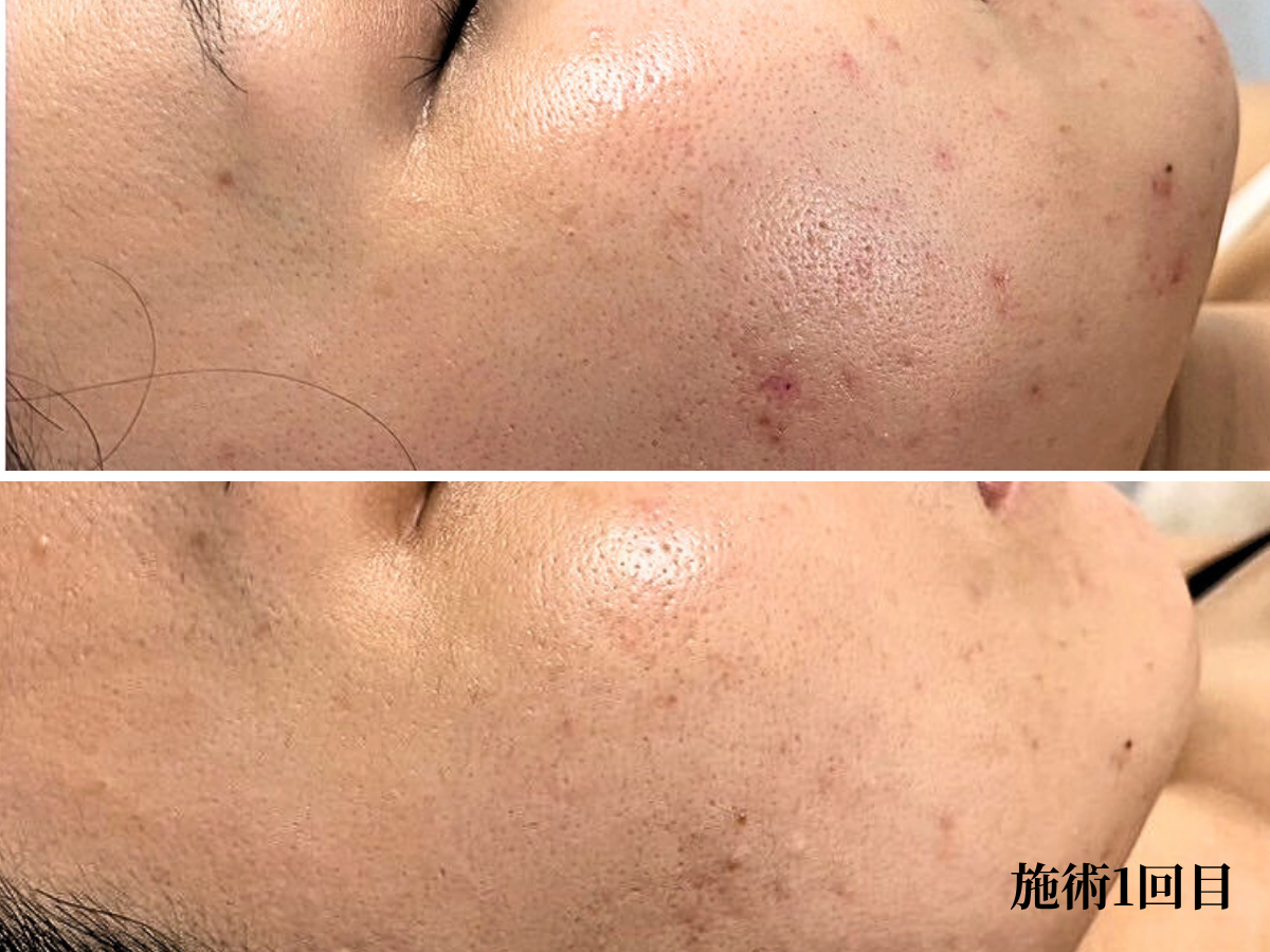 京都・四条烏丸のララピール｜施術1回目の効果写真