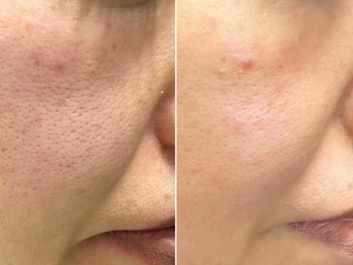 ダクトピールの施術でのbefore＆afterの写真