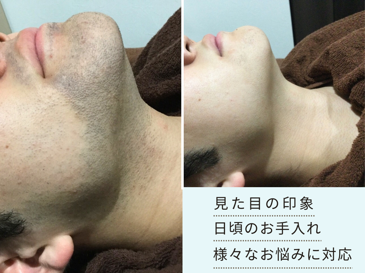 京都四条烏丸 ヒゲ脱毛 ビフォーアフター 症例写真