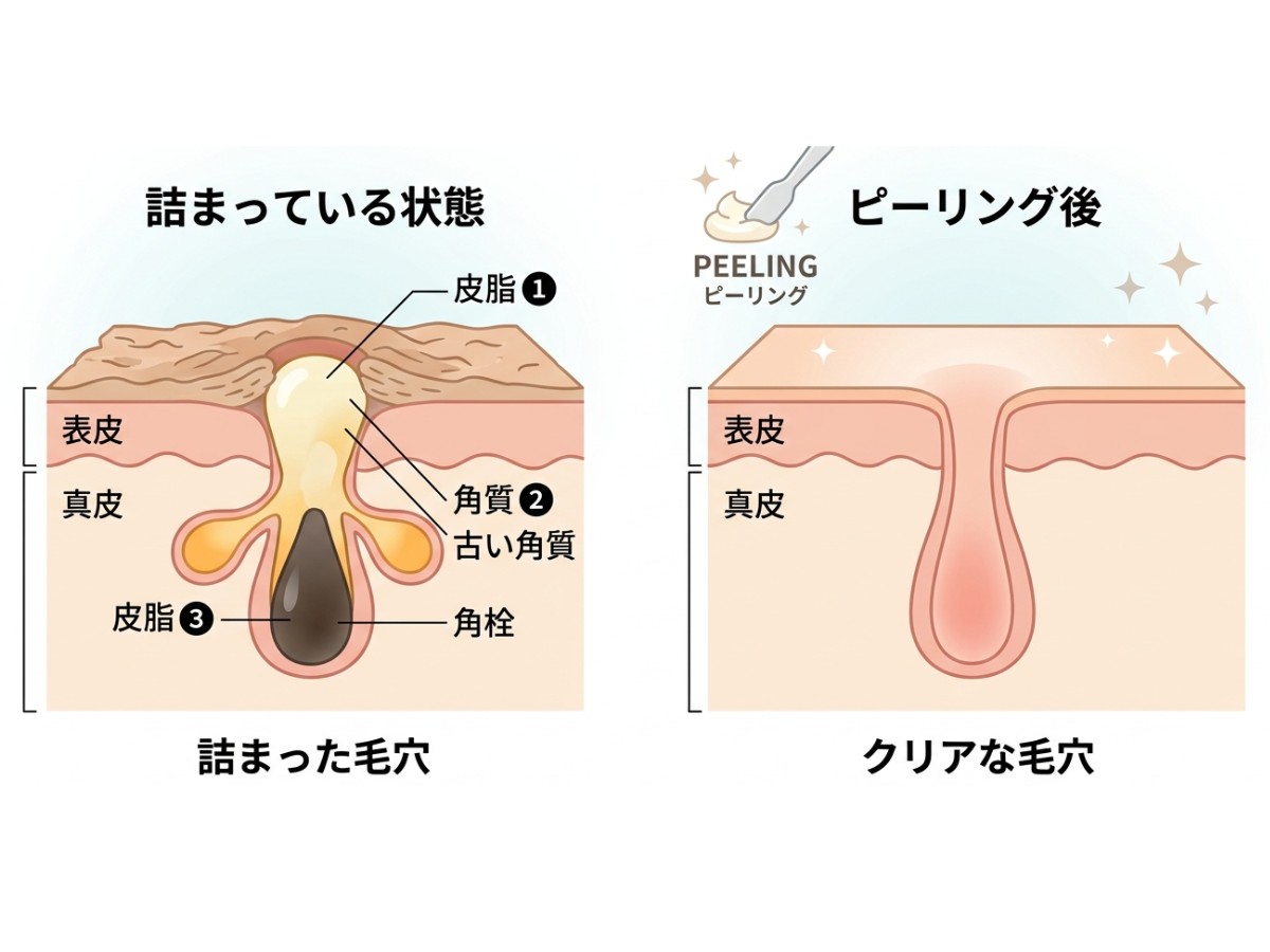 京都・四条烏丸｜毛穴の黒ずみの仕組みイラスト