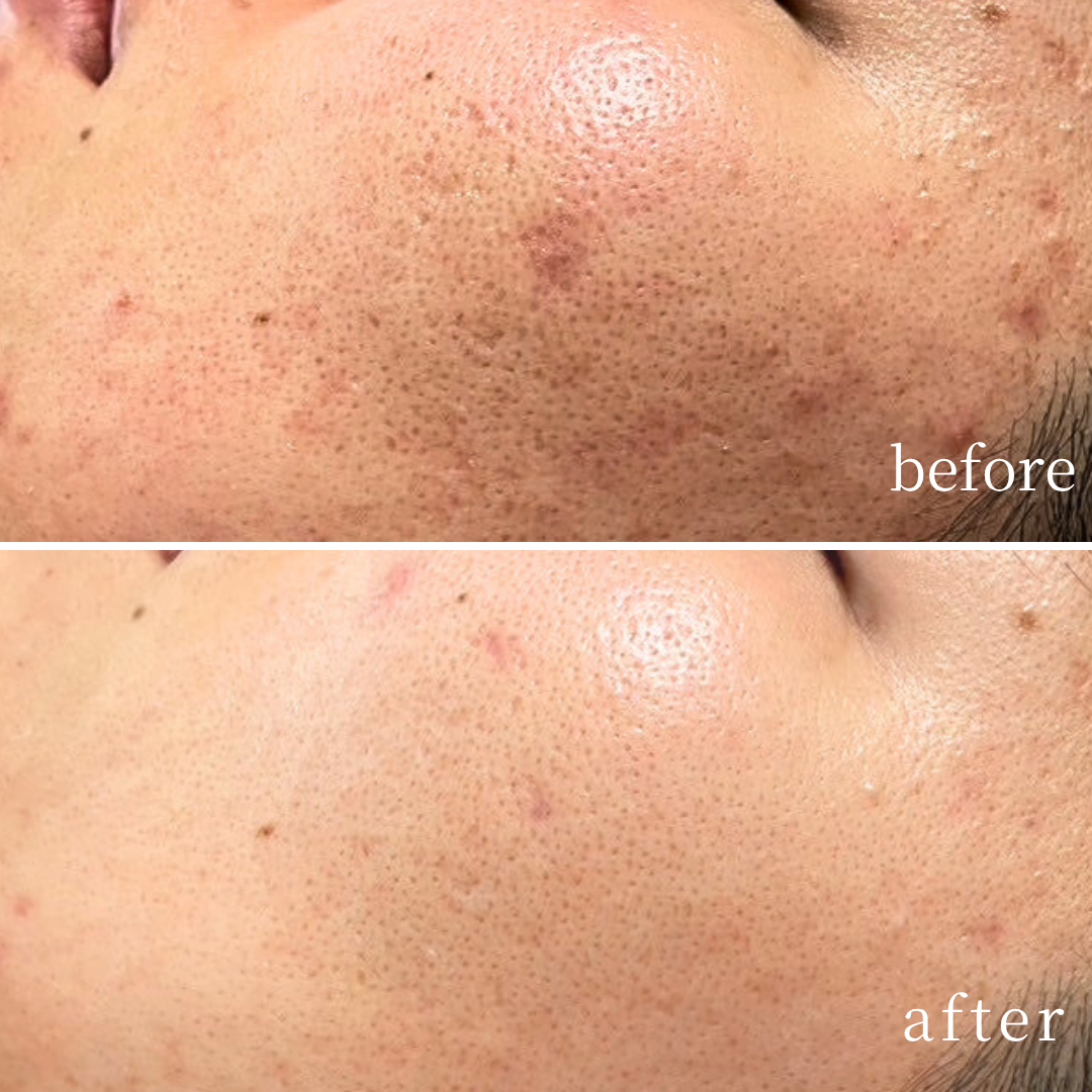 黒ずみの変化｜四条烏丸Soleilのピーリング効果