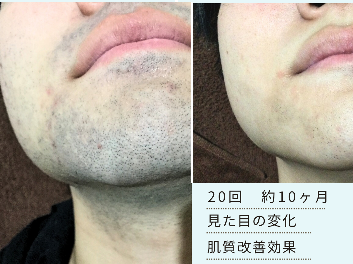 四条烏丸のヒゲ脱毛｜脱毛の回数と期間を見た目の変化で解説