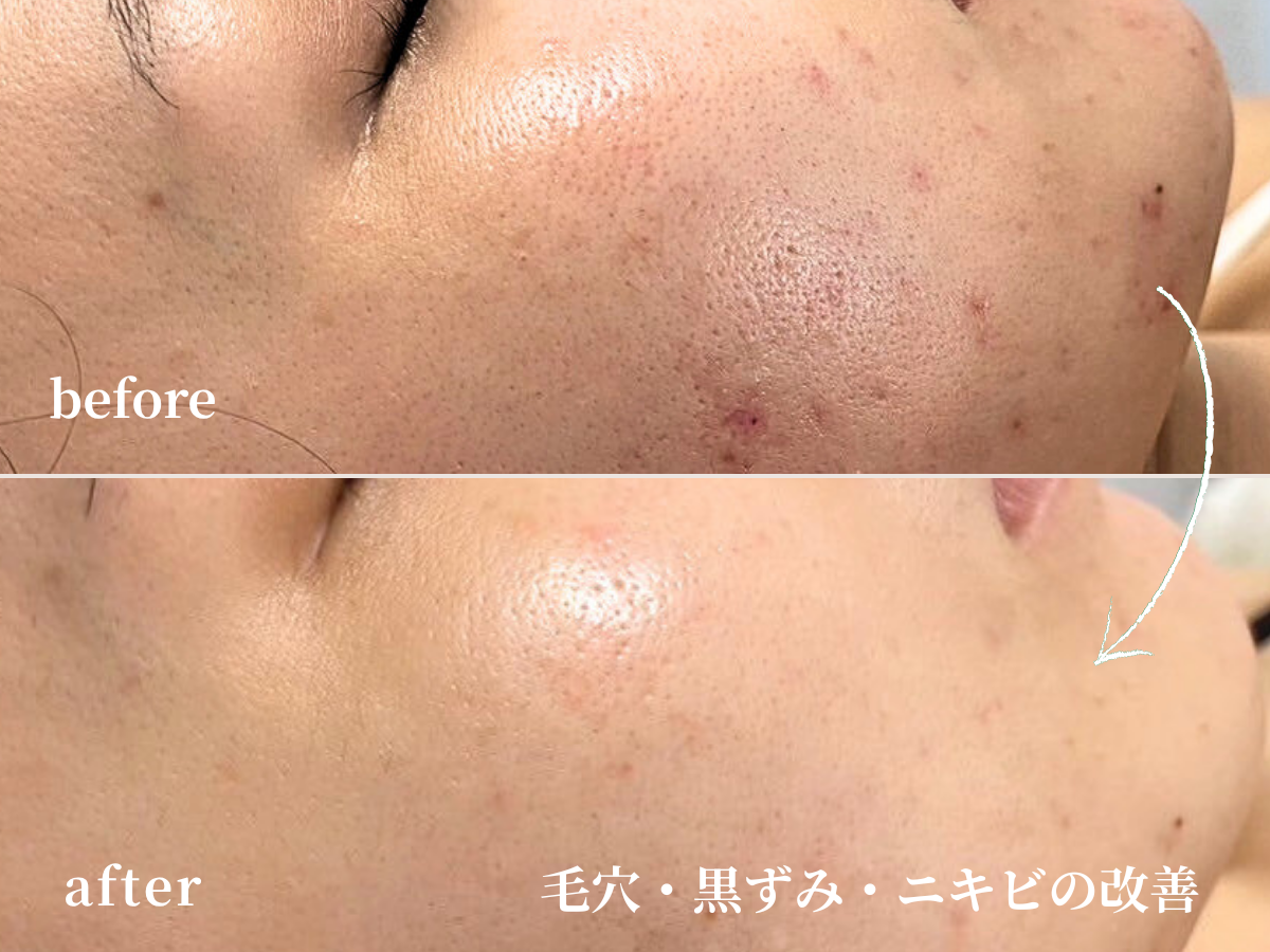 京都四条烏丸のSoleilで行うダクトピールのビフォーアフターの写真