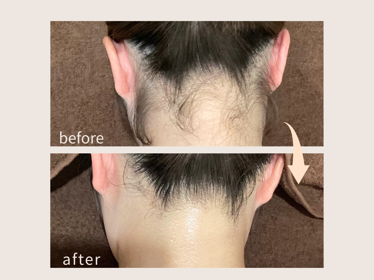 うなじ脱毛のビフォーアフターの写真