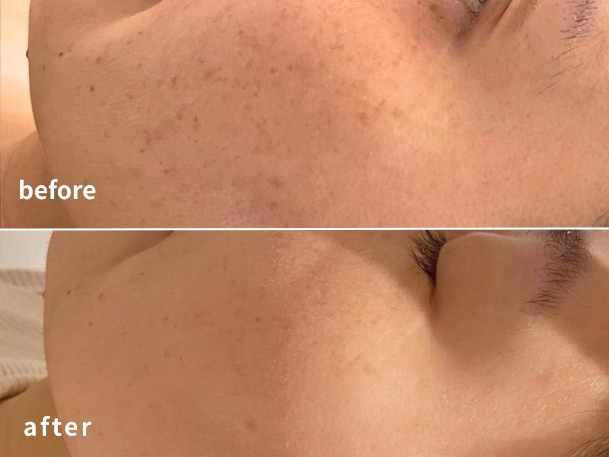 ダクトピールの施術でのbefore＆afterの写真２
