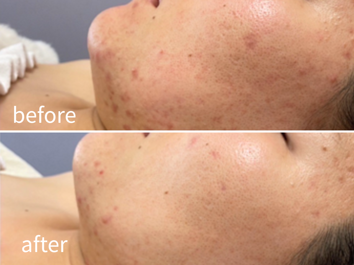 京都・四条烏丸｜肌のシミ・くすみのビフォーアフターの写真