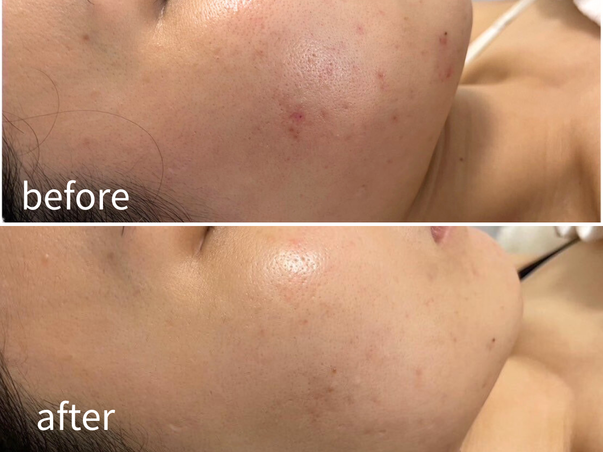 ララピール施術前後の比較