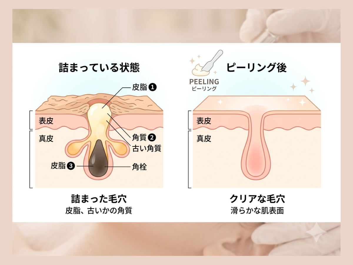 京都・四条烏丸のララピール｜ピーリング施術後イラスト