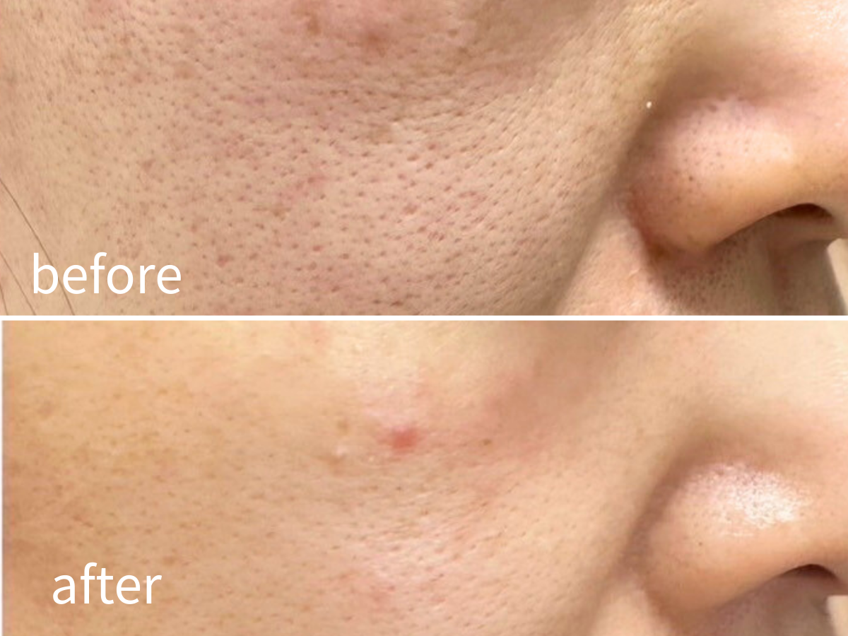 京都・四条烏丸｜肌のシワ・ホウレイ線のビフォーアフターの写真