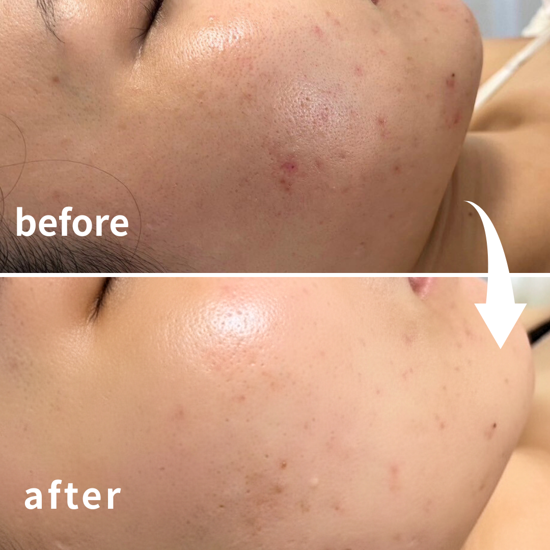 肌表面の変化｜四条烏丸Soleilのピーリング効果