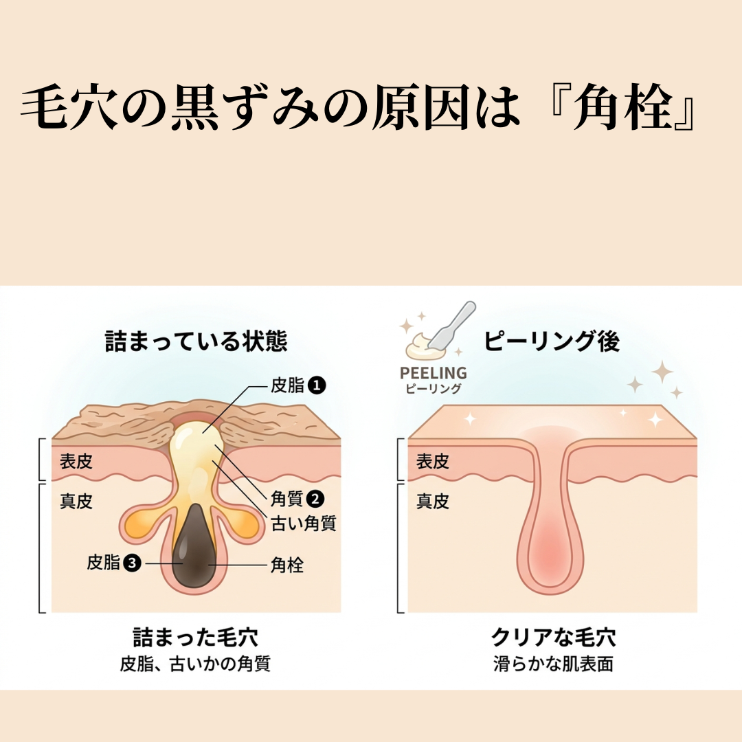毛穴の黒ずみの原因は角栓を表したイラスト