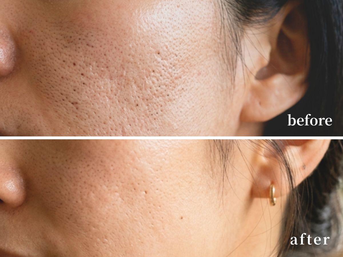 京都・四条烏丸｜光フェイシャルのビフォーアフターの写真