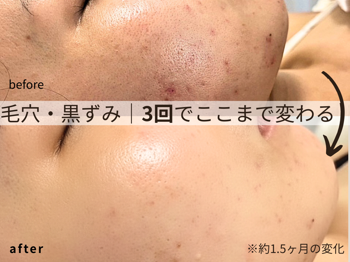 京都・四条烏丸Soleil｜毛穴特化ピーリングで肌質改善した写真