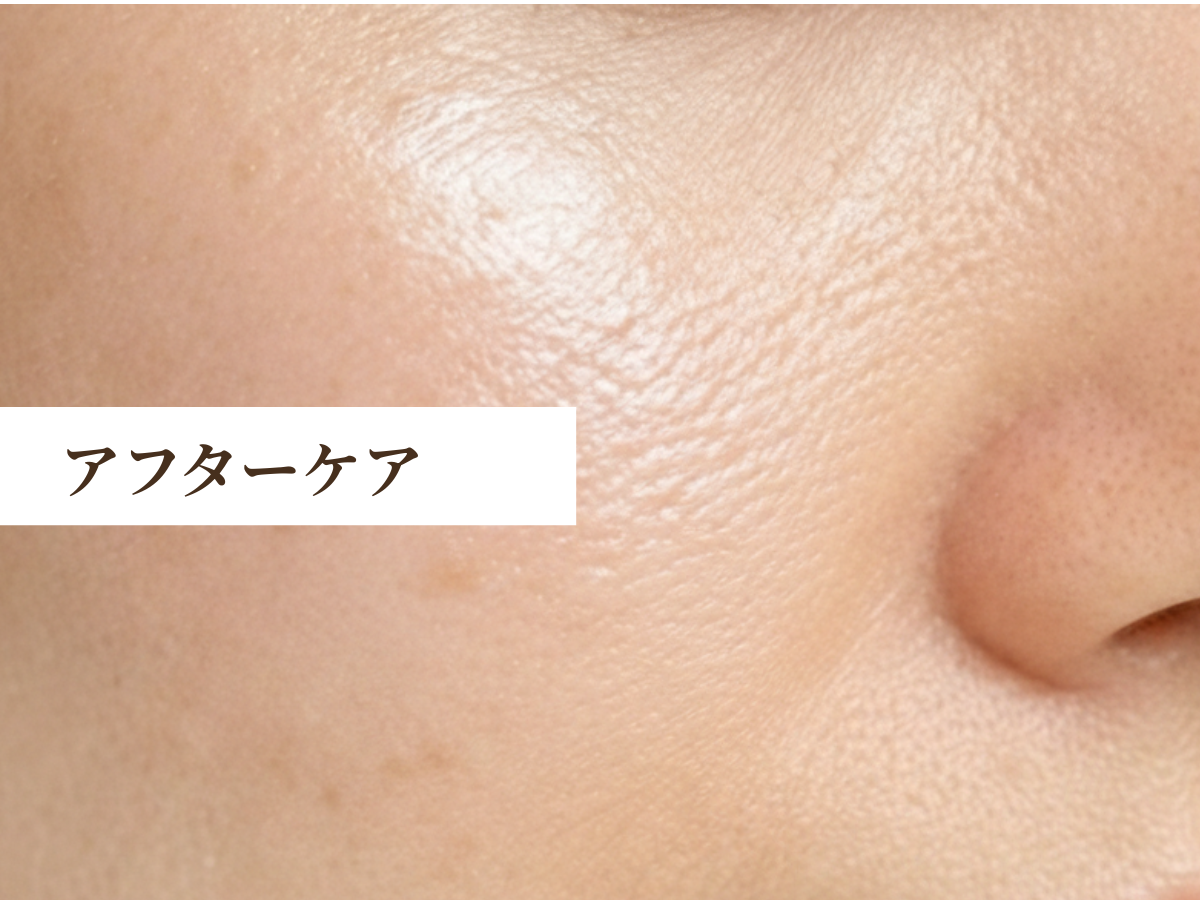 ララピール施術後のアフターケア。保湿と肌を落ち着かせ、透明感ある肌質改善をサポートする工程。