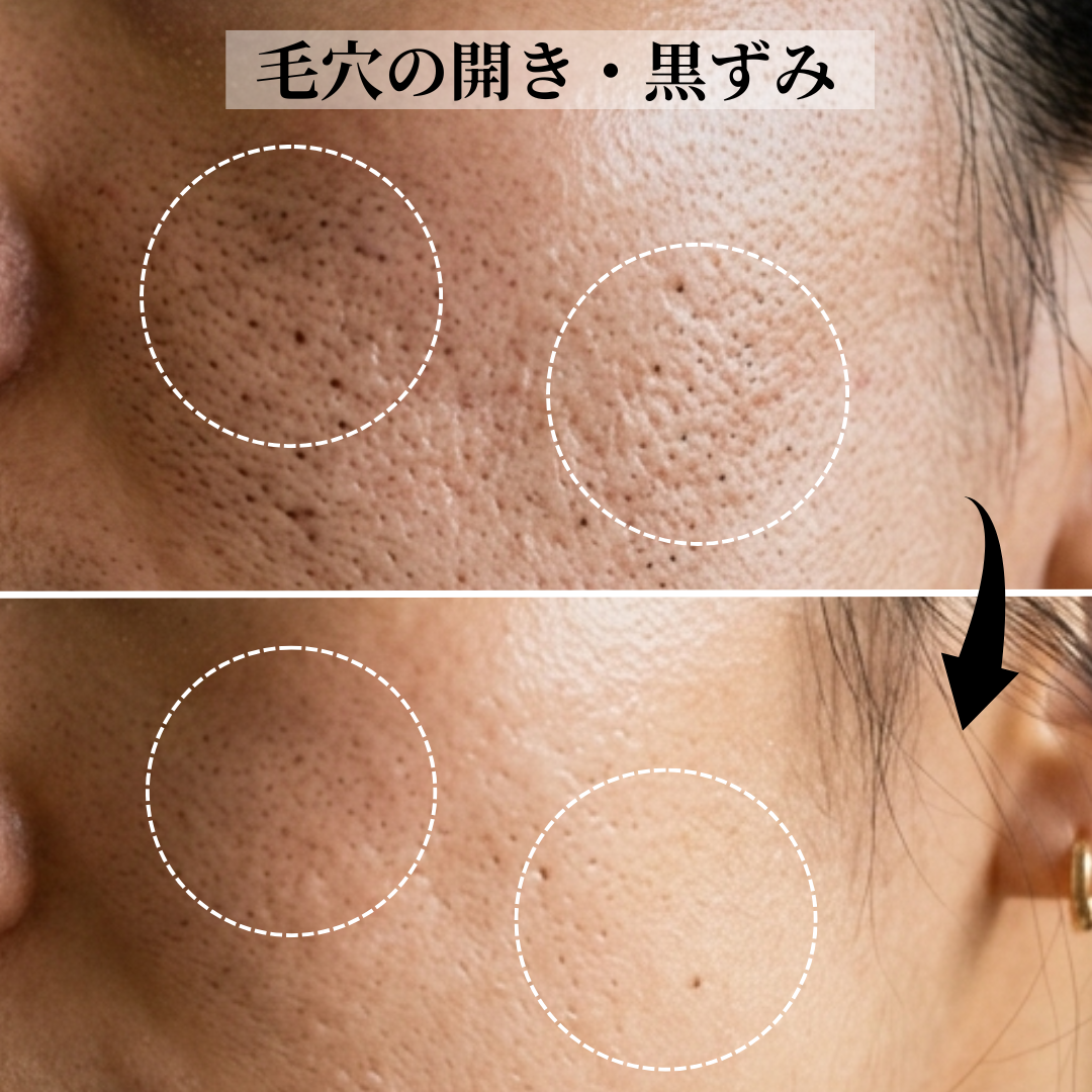 京都四条烏丸 毛穴の黒ずみや詰まりに悩む肌